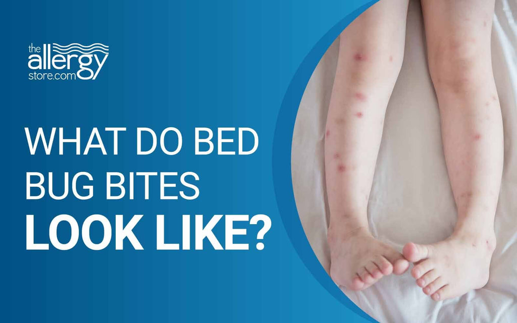 What Do Bed Bug Bites Look Like?